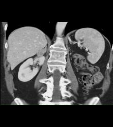 Recurrent Renal Cell Carcinoma Near Left Nephrectomy Site - CTisus CT Scan