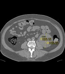 Cystic Renal Cell Carcinoma - CTisus CT Scan