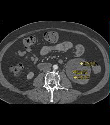 Cystic Renal Cell Carcinoma - CTisus CT Scan