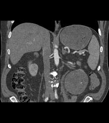 Cystic Renal Cell Carcinoma - CTisus CT Scan