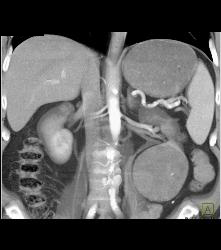 Cystic Renal Cell Carcinoma - CTisus CT Scan