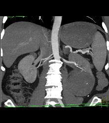 Cystic Renal Cell Carcinoma - CTisus CT Scan