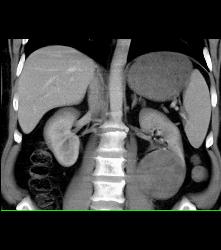 Cystic Renal Cell Carcinoma - CTisus CT Scan