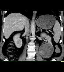 Cystic Renal Cell Carcinoma - CTisus CT Scan