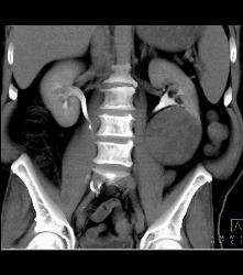 Cystic Renal Cell Carcinoma - CTisus CT Scan