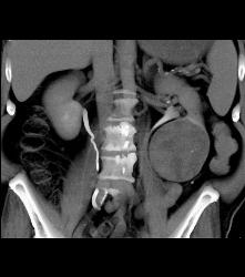 Cystic Renal Cell Carcinoma - CTisus CT Scan