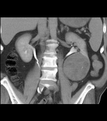 Cystic Renal Cell Carcinoma - CTisus CT Scan