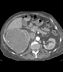 Renal Cell Carcinoma Invades the Inferior Vena Cava (IVC) - See Sequence - CTisus CT Scan