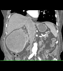 Renal Cell Carcinoma Invades the Inferior Vena Cava (IVC) - See Sequence - CTisus CT Scan