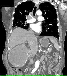 Renal Cell Carcinoma Invades the Inferior Vena Cava (IVC) - See Sequence - CTisus CT Scan