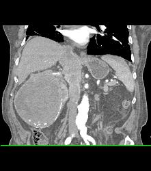 Renal Cell Carcinoma Invades the Inferior Vena Cava (IVC) - See Sequence - CTisus CT Scan