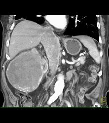 Renal Cell Carcinoma Invades the Inferior Vena Cava (IVC) - See Sequence - CTisus CT Scan