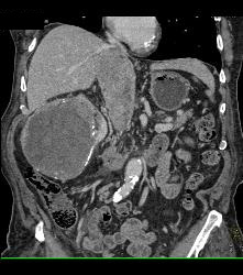 Renal Cell Carcinoma Invades the Inferior Vena Cava (IVC) - See Sequence - CTisus CT Scan