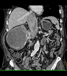 Renal Cell Carcinoma Invades the Inferior Vena Cava (IVC) - See Sequence - CTisus CT Scan