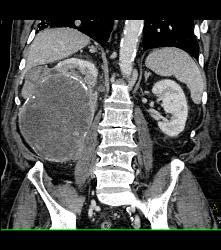 Renal Cell Carcinoma Invades the Inferior Vena Cava (IVC) - See Sequence - CTisus CT Scan