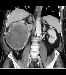 Renal Cell Carcinoma Invades the Inferior Vena Cava (IVC) - See Sequence - CTisus CT Scan