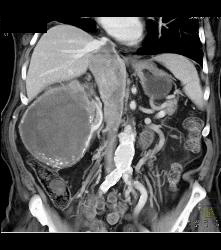 Renal Cell Carcinoma Invades the Inferior Vena Cava (IVC) - See Sequence - CTisus CT Scan