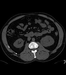 Classic Clear Cell Renal Cell Carcinoma- See Sequence - CTisus CT Scan