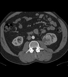 Classic Clear Cell Renal Cell Carcinoma- See Sequence - CTisus CT Scan