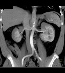 Classic Clear Cell Renal Cell Carcinoma- See Sequence - CTisus CT Scan