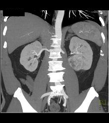 Classic Clear Cell Renal Cell Carcinoma- See Sequence - CTisus CT Scan