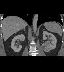 Classic Clear Cell Renal Cell Carcinoma- See Sequence - CTisus CT Scan