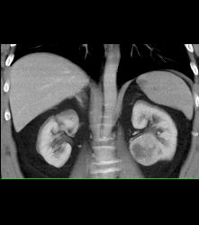 Classic Clear Cell Renal Cell Carcinoma- See Sequence - CTisus CT Scan