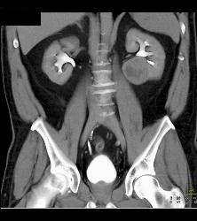 Classic Clear Cell Renal Cell Carcinoma- See Sequence - CTisus CT Scan