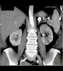 Bilateral Renal Artery Aneurysm - CTisus CT Scan