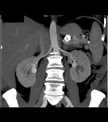 Bilateral Renal Artery Aneurysm - CTisus CT Scan