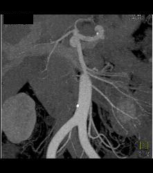 Bilateral Renal Artery Aneurysm - CTisus CT Scan