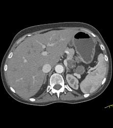 Lower Pole Right Renal Cell Carcinoma With Cystic Pancreatic Lesion in Von Hippel-Lindau syndrome (VHL) - See Sequence - CTisus CT Scan