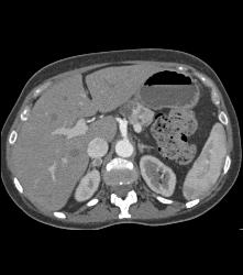 Lower Pole Right Renal Cell Carcinoma With Cystic Pancreatic Lesion in Von Hippel-Lindau syndrome (VHL) - See Sequence - CTisus CT Scan