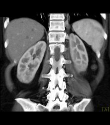 Lower Pole Right Renal Cell Carcinoma With Cystic Pancreatic Lesion in Von Hippel-Lindau syndrome (VHL) - See Sequence - CTisus CT Scan