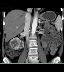 Lower Pole Right Renal Cell Carcinoma With Cystic Pancreatic Lesion in Von Hippel-Lindau syndrome (VHL) - See Sequence - CTisus CT Scan