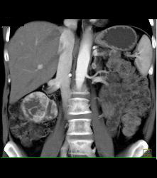 Lower Pole Right Renal Cell Carcinoma With Cystic Pancreatic Lesion in Von Hippel-Lindau syndrome (VHL) - See Sequence - CTisus CT Scan