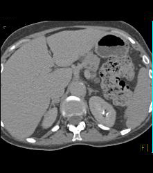 Bone Metastases From Renal Cell Carcinoma - CTisus CT Scan