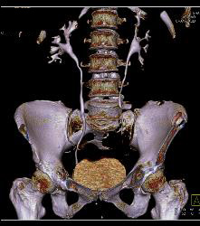 Bone Metastases From Renal Cell Carcinoma - CTisus CT Scan