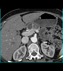 Bone Metastases From Renal Cell Carcinoma - CTisus CT Scan