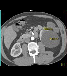 Pole Right Renal Cell Carcinoma With Cystic Pancreatic Lesion in Von Hippel-Lindau syndrome (VHL) - CTisus CT Scan