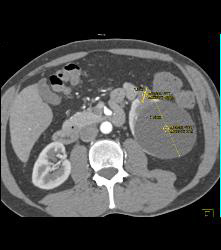 Cystic Renal Cell Carcinoma - CTisus CT Scan