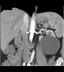 Cystic Renal Cell Carcinoma - CTisus CT Scan