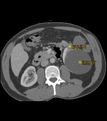 Cystic Renal Cell Carcinoma - CTisus CT Scan