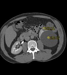 Cystic Renal Cell Carcinoma - CTisus CT Scan