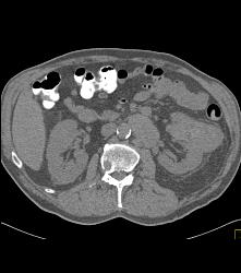 Renal Cell Carcinoma With Bone Metastases - CTisus CT Scan