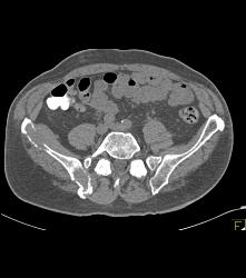 Renal Cell Carcinoma With Bone Metastases - CTisus CT Scan