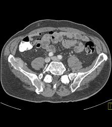 Renal Cell Carcinoma With Bone Metastases - CTisus CT Scan