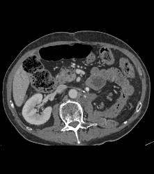 Recurrent Renal Cell Carcinoma - CTisus CT Scan