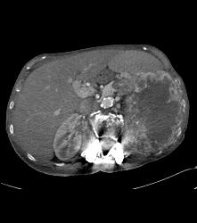 Renal Cell Carcinoma With Spread Through Diaphragm - CTisus CT Scan