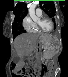 Renal Cell Carcinoma With Spread Through Diaphragm - CTisus CT Scan